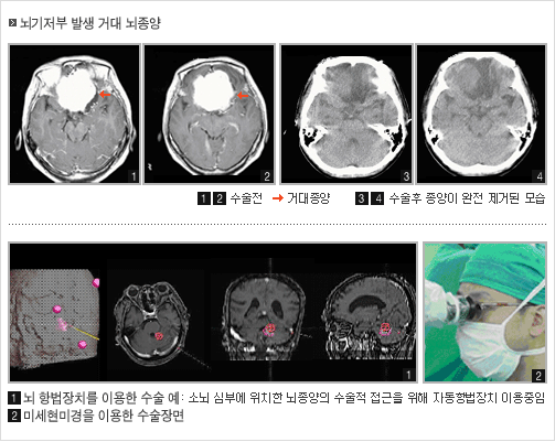  		뇌기저부 발생 거대 뇌종양 		1번,2번 이미지 : 수술전 -> 거대종양 		3번,4번 이미지 : 수술후 종양이 완전 제거된 모습 		 		1번 이미지 : 뇌 항법장치를 이용한 수술 예 : 소뇌 심부에 위차한 뇌종양의 수술적 접근을 위해 자동항법장치 이용중임 		2번 이미지 : 미세현미경을 이용한 수술장면 		