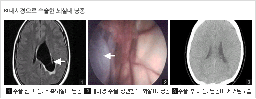  	1번 수술 전 사진 : 좌측뇌실내 낭종 	2번 내시경 수술 장면 흰색 화살표:낭종 	3번 수술 후 사진 : 낭종이 제거된 모습 	