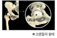  	고관절의 형태 이미지 	