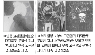  		 인공 고관절전치환술 대퇴골두 무혈성 괴사환자에서 인공 고관절 전치환술을 시행 		 MRI 촬영 : 양측 고관절의 대퇴골두무혈성 괴사 소견(화살표)을 보이고 있으며 좌측에 비해서 우측 고관절의 무활성괴사가 더욱 진행하였음 		 