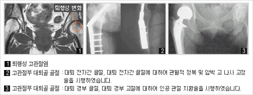  		 1. 퇴행성 고관절염 		 2. 고관절부 대퇴골 골절 : 대퇴 전자간 골절, 대퇴 전자간 골절에 대하여 관혈적 정복 및 압박 고 나사 고정술을 시행하였습니다. 		 3. 고관절부 대퇴골 골절 : 대퇴 경부 골절, 대퇴 경부 고절에 대하여 인공 관절 치환술을 시행하였습니다. 		 