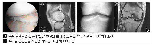  	1. 우측 슬관절의 내측 반월상 연골의 퇴행성 파열의 진단적 관절경 및 MRI 소견 	2. 박리성 골연골염의 단순 방사선 소견 및 MRI소견 	