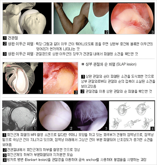  			  1. 견관절 			  2. 상완 이두근 파열 : 특징-그림과 같이 이두근이 튀어나오도록 힘을 주면 상완부 중간에 볼록한 이두근의 덩어리가 현저하게 나타나는 것 			  3. 상완 이두근 파열 : 관절경으로 상완 이두근의 장두가 견관절 내에서 파열된 소견을 확인한 것 			   			  상부 관절와 순 파얼(SLAP lesion) 			  1. 상완 관절와 순이 파열된 소견을 도식화한 것으로 상부 관절화로부터 관절와 순의 접촉이 손실된 소견을 보이고 있음 			  2. 관절경을 이용 상완 관절와 순 파열을 확인한 것 			   			  1. 회전근개 파열의 MRI 촬영 소견으로 길다란 주머니 모양을 하고 있는 회색부가 견봉하 점액낭으로, 점액낭밑으로 극상근건이 지나가고 있으며,점액낭 아래에서 그상근 건이 부분 파열되어 신호강도가 증가한 소견을 보여줌. 			  2. 견과절내에서 회전근개으 ㅣ하부를 촬영한 것으로 정상 			  3. 회전근개의 하부가 부분 파열되어 지저분한 모습 			  4.방카트 병변(Bankart lesion)을 관절경을 이용하여 금속 anchor를 사용하여 봉합술을 시행하는 고정 			  