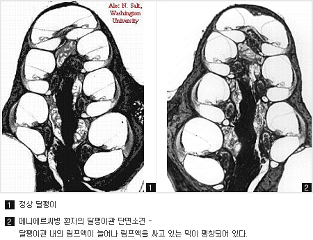 왼쪽에는 정상 달팽이 이미지 / 오른쪽에는 메니에르씨병 환자의 달팽이관 단면소견 - 달팽이관 내의 림프액이 늘어나 림프액을 싸고 있는 막이 팽창되어 있다.