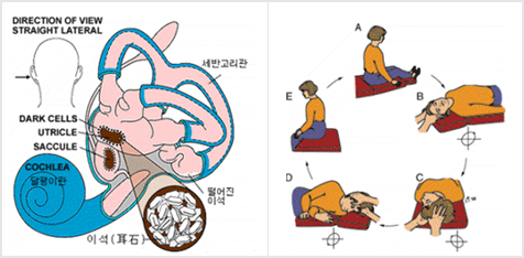  	양성 발작성 체위변환성 현훈 이미지 	