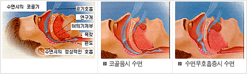 수면시의 코골기 / 코골음시 수면/ 수면무호흡증시 수면