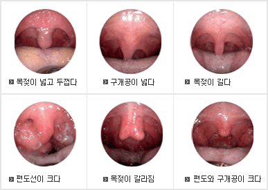 목젖이 넓고 두껍다/구개공이 넓다/목젖이 길다/편도선이 크다/목젖이 갈라짐/편도와 구개공이 크다