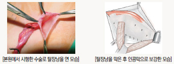 좌측 이미지는 본원에서 시행한 수술로 탈장님을 연 모습이고, 우측 이미지는 탈장낭을 막은 후 인공막으로 보강한 모습입니다.
