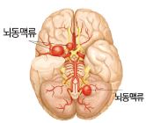 뇌동맥류 구조 이미지