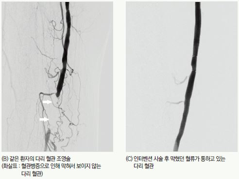 좌측 이미지는 같은 환자의 다리 혈관조영술 (화살표는 혈관병증으로 인해 막혀서 보이지 않는 다리 혈관 이미지) 이고, 우측 이미지는 인터벤션 시술 후 막혔던 혈류가 통하고 있는 다리 혈관 입니다.