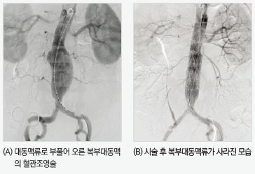좌측 이미지는 대동맥류로 부풀어 오른 복부대동맥의 혈관조영술이고, 우측 이미지는 시술 후 복부대동맥류가 사라진 모습 입니다.