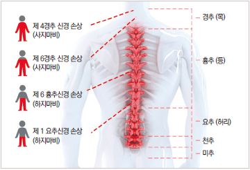 척수손상의 정의 이미지