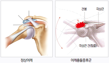 좌측 정상어깨의 이미지 / 우측 어깨충돌증후군의 이미지
