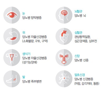  눈 당뇨병 망막병증 위 당뇨병 자율신경병증 (소화불량, 구토, 구역) 생식기 당뇨병 자율신경병증 (성기능장애) 뇌혈관 당뇨병 뇌 심혈관 관상동맥질환, 심근경색증, 심부전 신장 당뇨병 신증 발 당뇨병 족부병변 말초신경 당뇨병 신경병증 (저림, 감각저하, 통증)