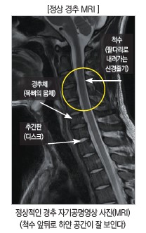  [정상 경추 MRI] 척수 (팔다리로 내려가는 경추체 (목뼈의 몸체) 신경줄기) 추간판 (디스크) 정상적인 경추 자기공명영상 사진(MRI) (척수 앞뒤로 하얀 공간이 잘 보인다)