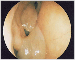 부비동염 물혹 관련 이미지
