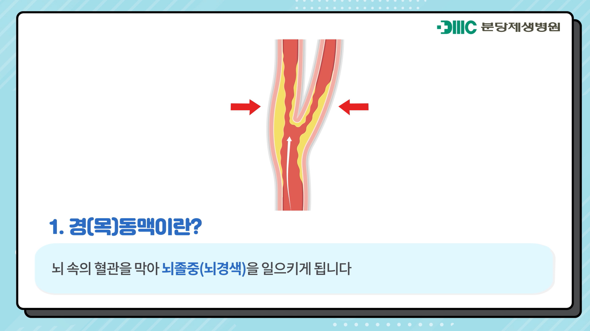 경동맥 협착증의 치료 방법(약물치료, 수술적 치료, 혈관 내 치료)