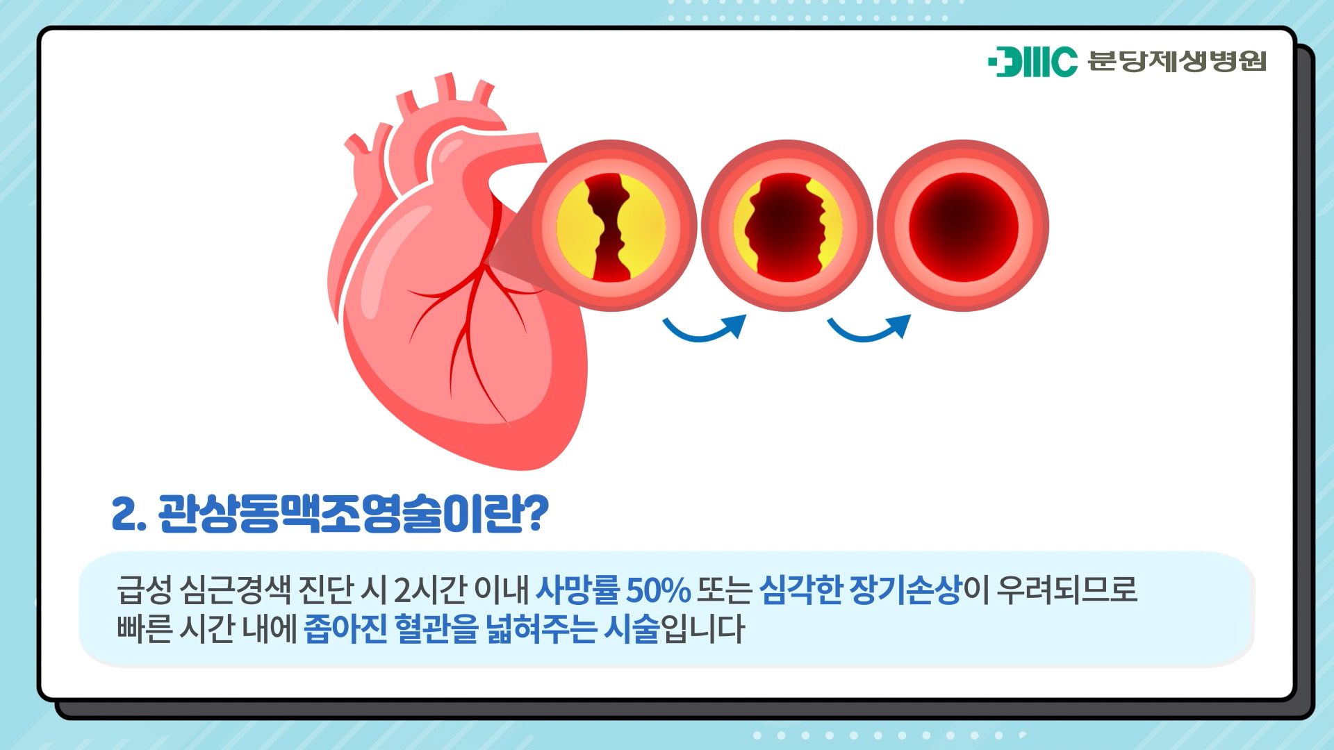 좁아진 혈관을 넓혀주는 관상동맥조영술