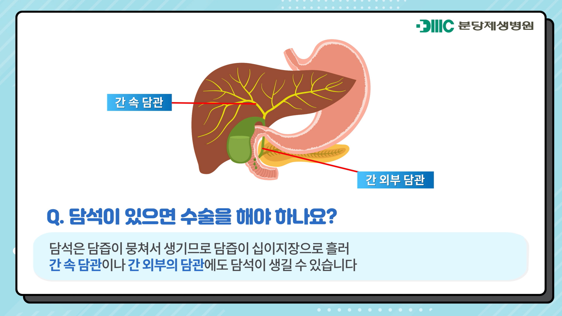 담낭(쓸개)에 생기는 병 - 담석과 담낭 용종