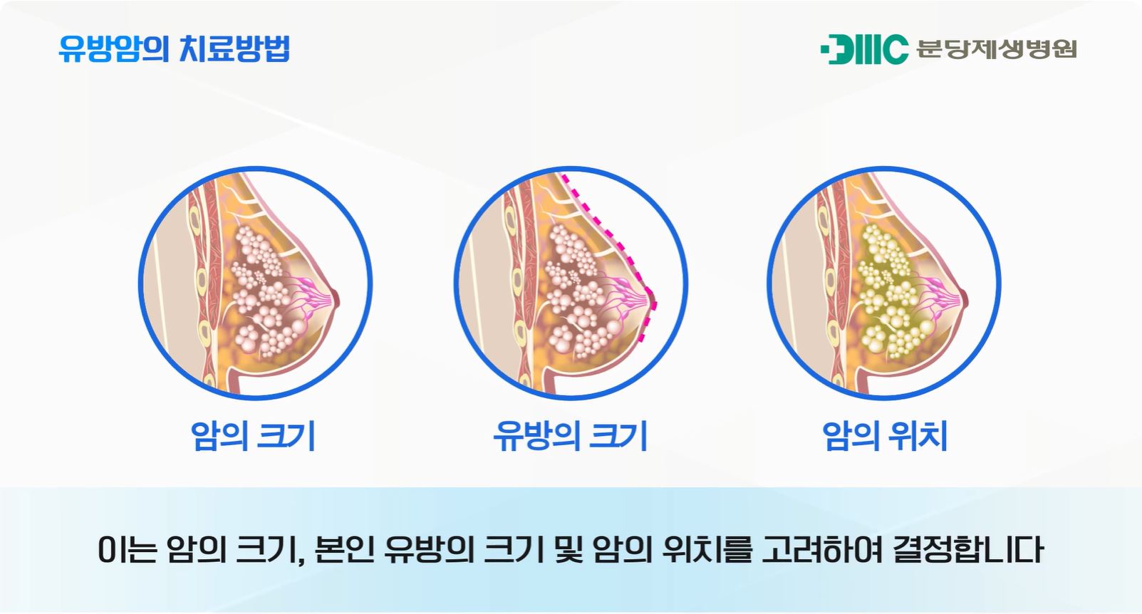 유방암의 발병률과 예후