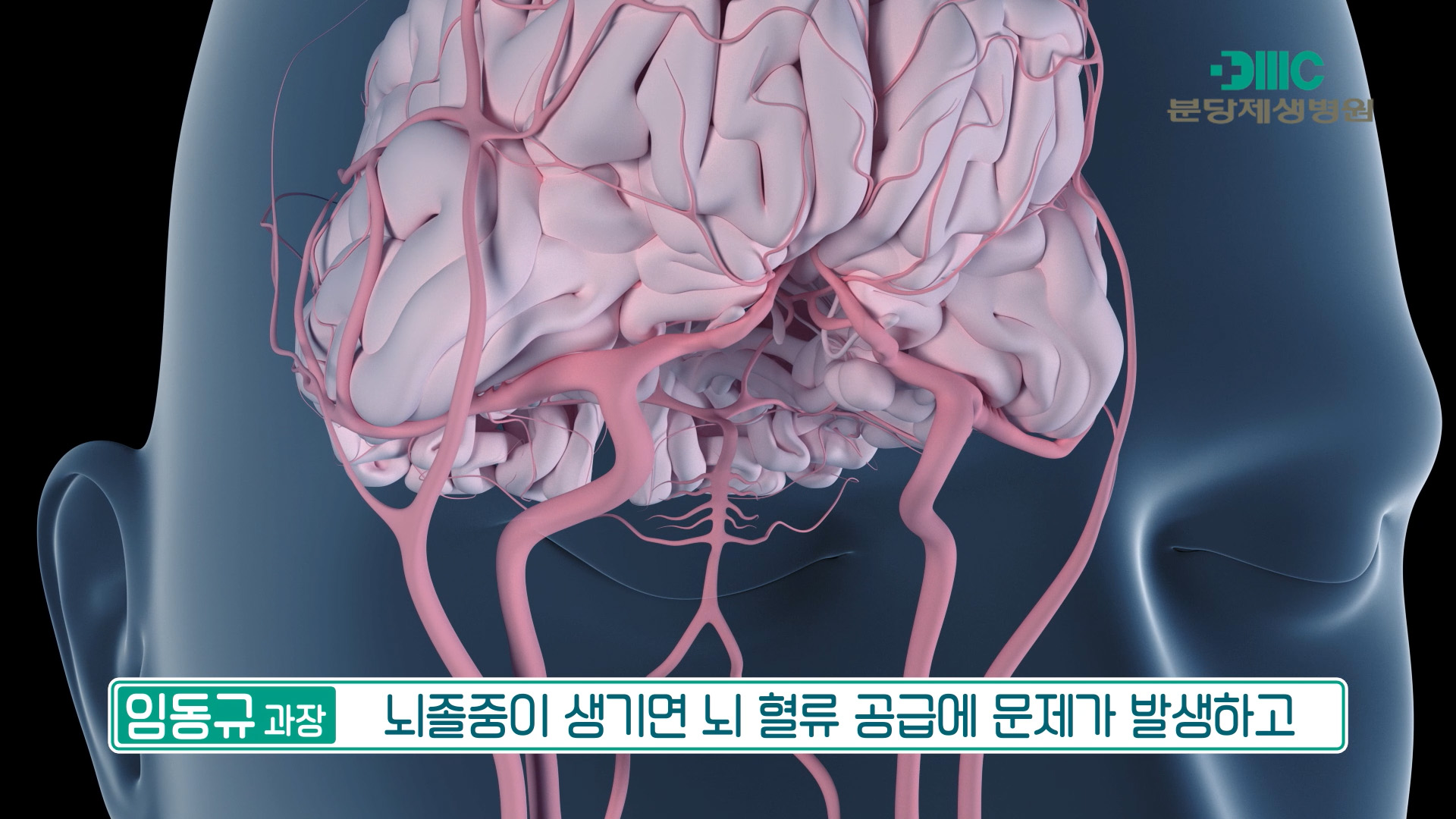 뇌졸중(뇌경색, 뇌출혈)이란 무엇인가요