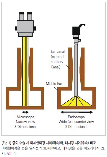 중이 수술 시 미세현미경 시야(좌측)와, 내시경 시야(우측) 비교 미세현미경은 좁은 일직선의 3D시야이고, 내시경은 넓은 파노라마식 2D 시야입니다.