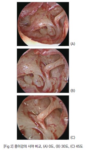 [fig2] 중이강의 시야 비교, (A) 0도, (B) 30도, (C) 45도