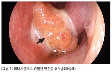 [그림1] 비내시경으로 관찰된 반전성 유두종(화살표)