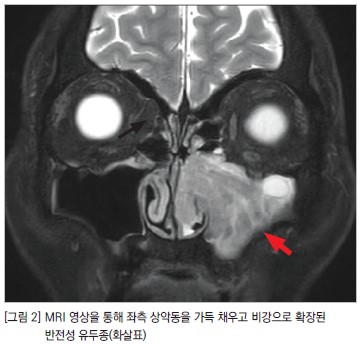 MRI 영상을 통해 좌측 상악동을 가득 채우고 비강으로 확장된 반전성 유두종 사진