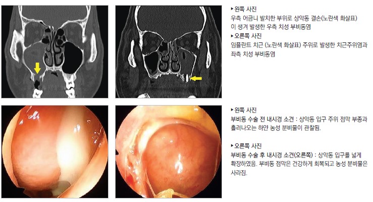 왼쪽사진 : 우측 어금니 발치한 부위로 상악동 결손(노란색 화살표). 오른쪽 사진 : 임플란트 치근(노란색 화살표) 주위로 발생한 치근주위염과 좌측 치성 부비동. 왼쪽사진 : 부비동 수술 전 내시경 소견 : 상악동 입구 주위 점막 부종과 흘러나오는 하얀 농성 분비물이 관찰됨. 오른쪽 사진 : 부비동 수술 후 내시경 소견(오른쪽): 상악동 입구를 넓게 확장하였음, 부비동 점막은 건강하게 회복되고 농성 분비물은 사라짐.