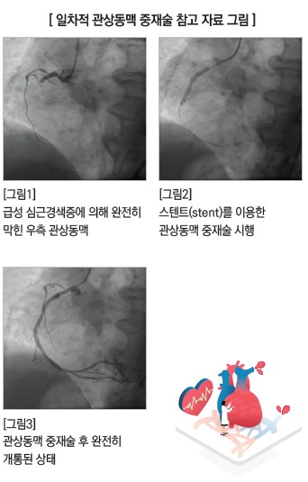 [일차적 관상동맥 중재술 참고 자료그림]. [그림1] 급성 심근경색증에 의해 완전히 막힌 우측 관상동맥, [그림2] 스탠트(stent)를 이용한 관상동맥 중재술 시행, [그림3] 관상동맥 중재술 후 완전히 개통된 상태
