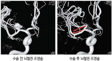 좌측 이미지는 수술 전 뇌혈관 조영술 / 우측 이미지는 수술 후 뇌혈관 조영술 사진입니다.