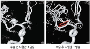 수술 전 뇌혈관 조영술, 수술 후 뇌혈관 조영술