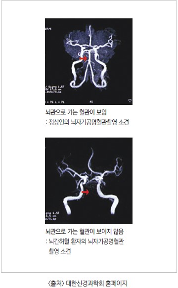 뇌관으로 가는 혈관이 보임: 정상인의 뇌자기공명혈관촬영 소견, 뇌관으로 가는 혈관이 보이지 않음: 뇌간허혈 환자의 뇌자기공명혈관 촬영 소견. 출처 대한신경과학회 홈페이지