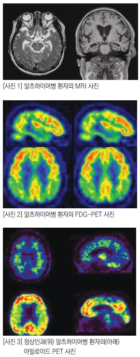 첫번째 이미지는 알츠하이머병 환자의 mri 사진 / 두번째 이미지는 알츠하이머병 환자의 fdg-pet 사진 / 세번째 이미지는 정상인과 알츠하이머병 환자의 아밀로이드 pet 비교 사진 입니다.