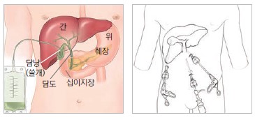 좌측 이미지는 경피경간 담날 배액술로 담낭을 찔러 담즙을 배액 하는 시술 이미지 입니다. 우측 이미지는 북강경 담낭절제술 이미지 입니다.