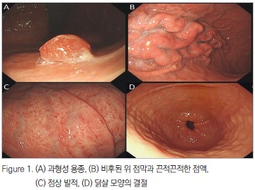 Figure 1. (A) 과형성 용종, (B)비후된 위 점막과 끈적끈적한 점액, (C) 정상발적, (D) 닭살모양의결절