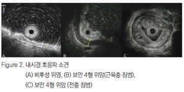 Figure 2. (A) 비후성 위염, (B)보만 4형 위암(근육층 침범), (C) 보만 4형 위암(전층 침범)