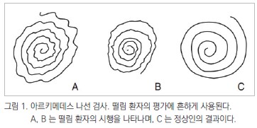 그림1. 아르키메데스 나선 검사, 떨림 환자의 평가에 흔하게 사용된다. A,B는 떨림 환자의 시행을 나타나며, C는 정상인의 결과이다.
