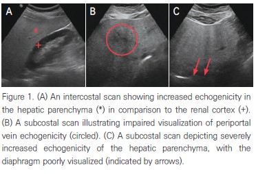 Figure 1. (A) An intercostal scan showing increased echogenicity in the hepatic parenchyma (*) in comparison to the renal cortex (+). (B) A subcostal scan illustrating impaired visualization of periportal vein echogenicity (circled). (C) A subcostal scan depicting severely increased echogenicity of the hepatic parenchyma. with the diaphragm poorly visualized (indicated by arrows).