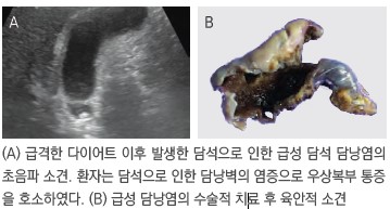 (A) 급격한 다이어트 이후 발생한 담석으로 인한 급성 담석 담낭염의 초음파 소견. 환자는 담석으로 인한 담낭벽의 염증으로 우상복부통증 을 호소하였다. (B) 급성 담낭염의 수술적 치료 후 육안적 소견
