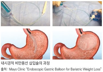 내시경적 비만풍선 삽입술의 과정 출처: Mayo Cinic Endoscopic Gastric Ballon for Bariatric Weight Loss