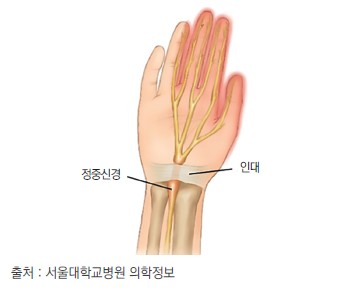 출처 : 서울대학교병원 의학정보