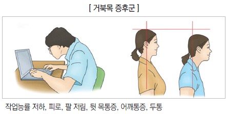 [거북목 증후군] 작업능률 저하, 피로, 팔 저림, 뒷 목통증, 어깨통증, 두통