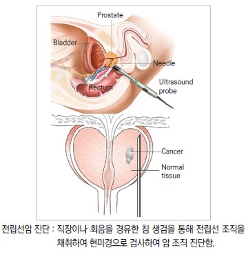 전립선암 진단 : 직장이나 회음을 경유한 침 생검을 통해 전립선 조직을 채취하여 현미경으로 검사하여 암 조직을 진단함.